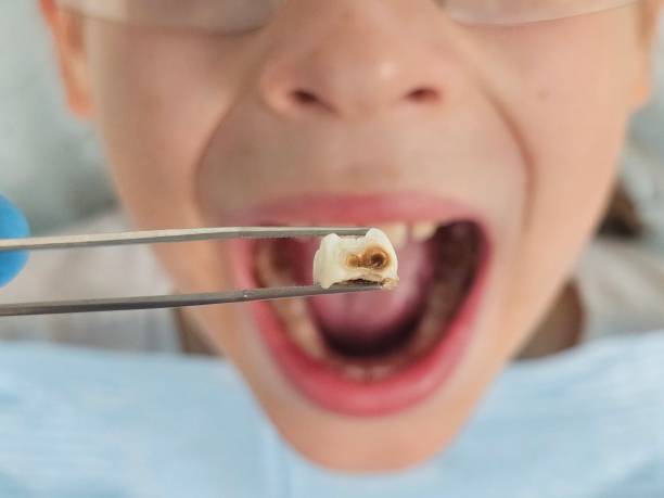 Best Emergency Root Canal Treatment in Berkshire Lakes, FL